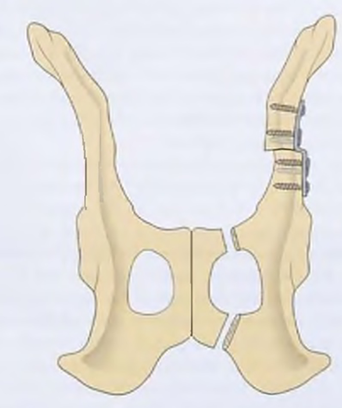 тделении участка тазовой кости с впадиной сустава