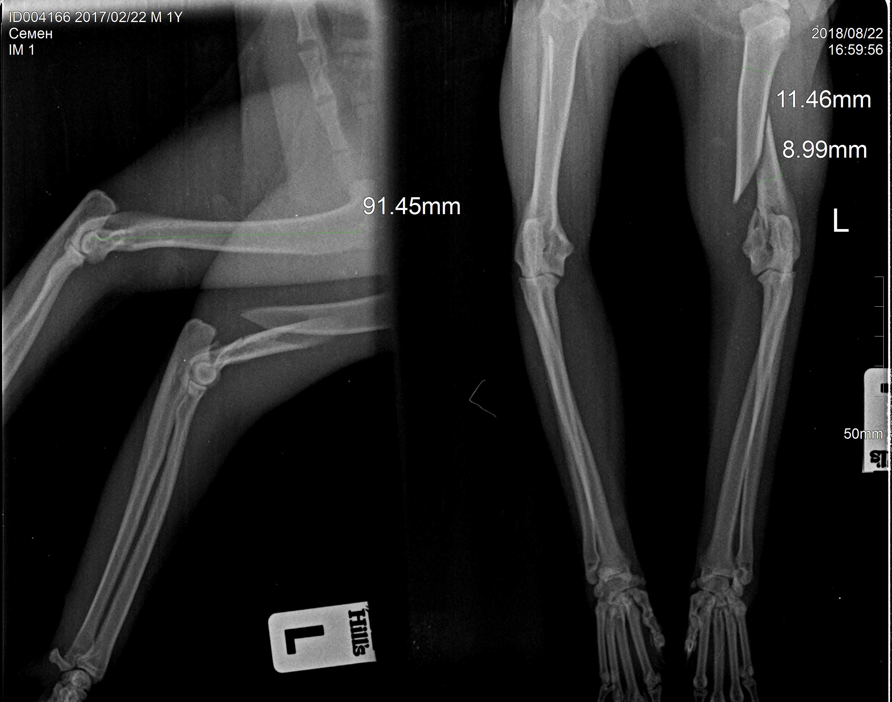 снимок раздробленного перелома плечевой кости у кота